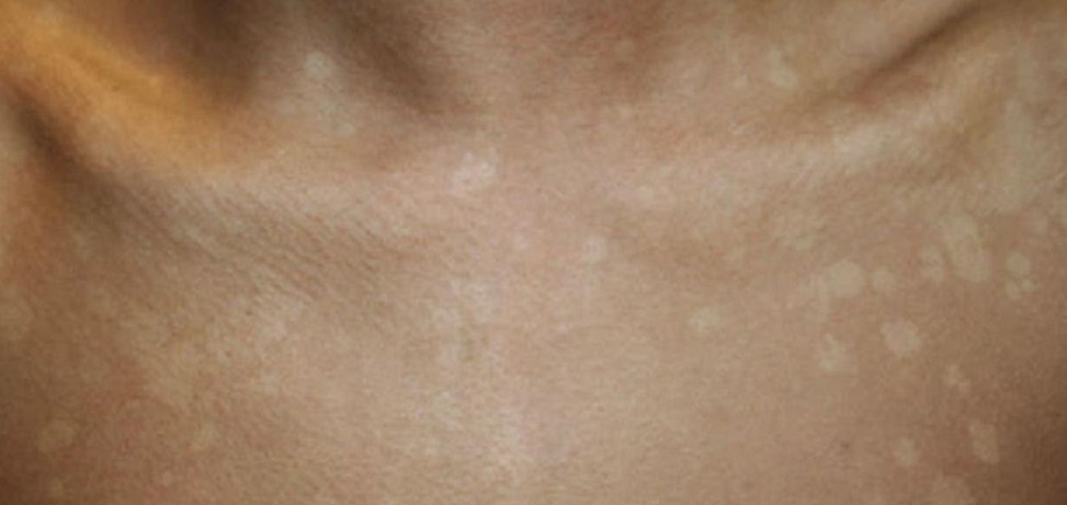 how does tanning bed rash look like