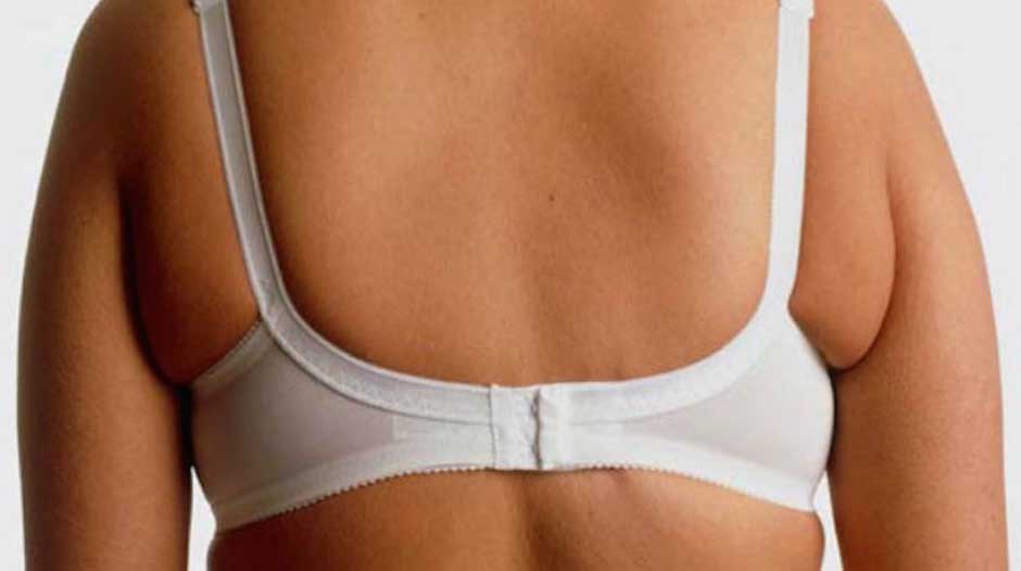 What causes bra bulge
