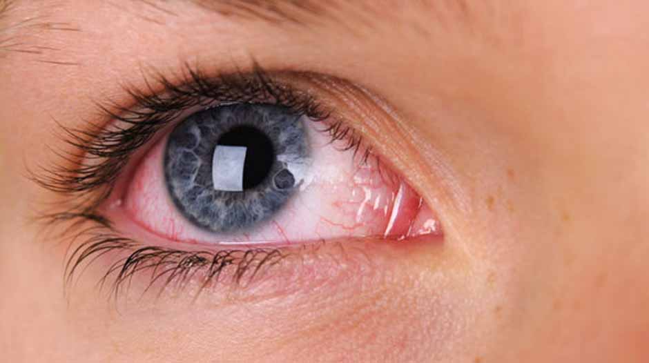 How to treat bloodshot eyes after eyelash extensions