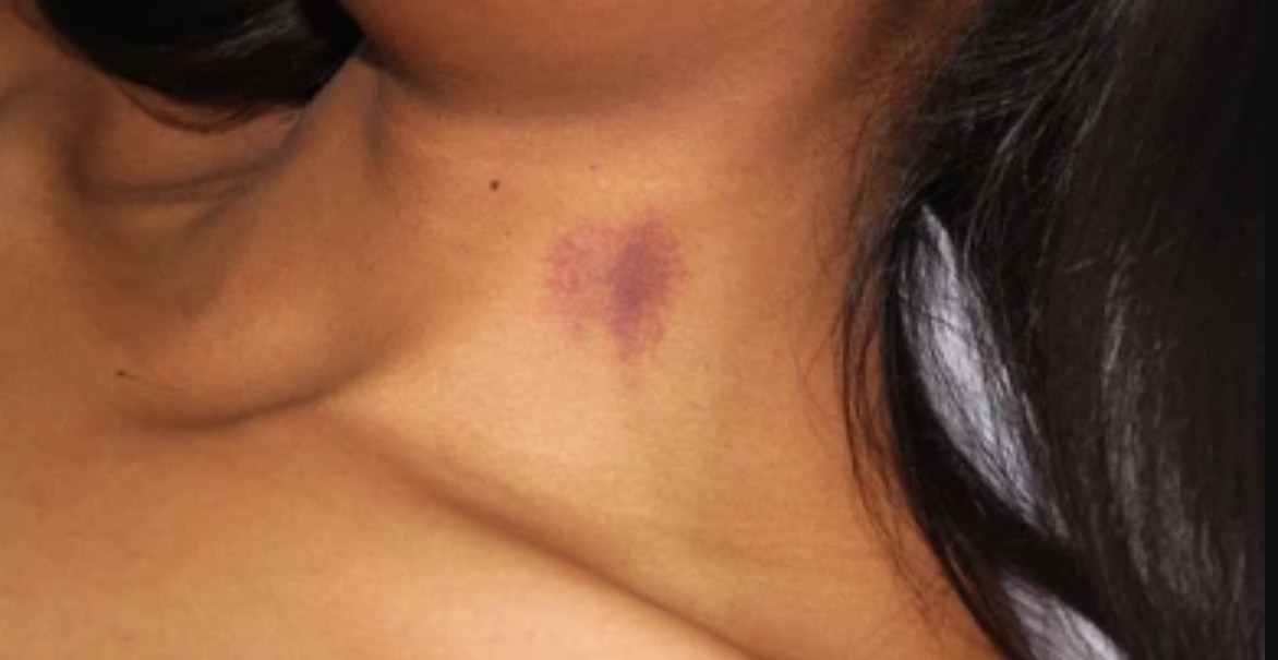 How to Get Rid of a Hickey