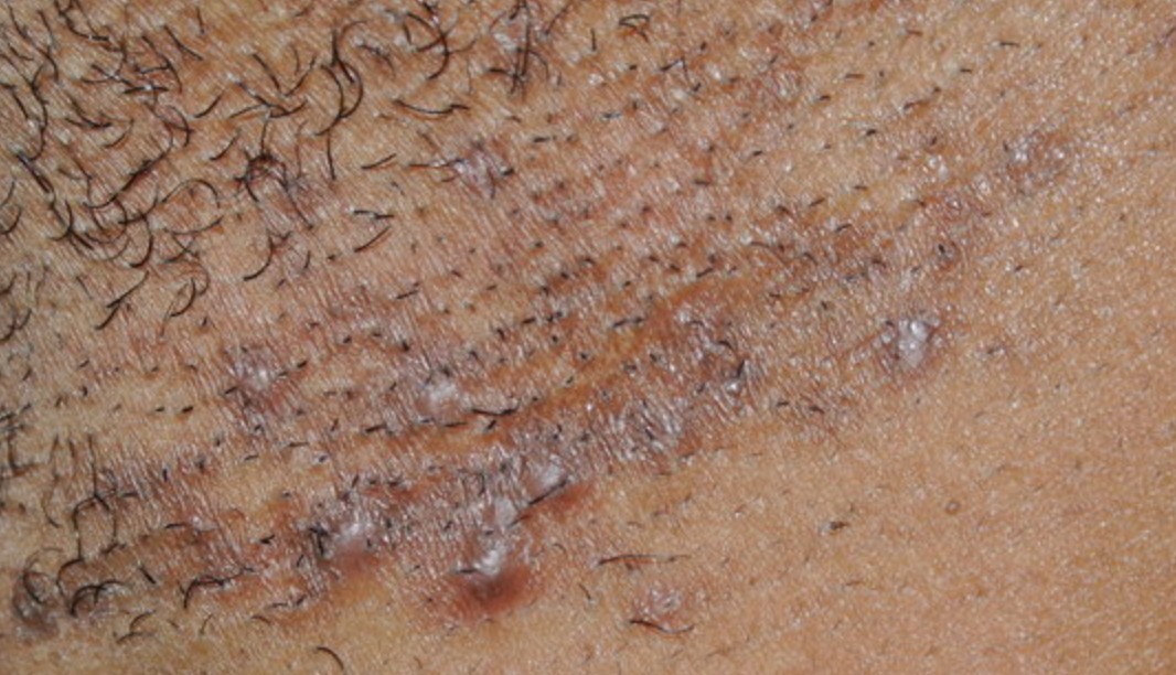 how to take care of ingrown hair scars