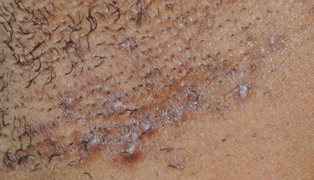 How to Get Rid of Ingrown Hair Scars